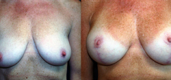 Breast Lift Result The Woodlands