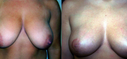 breast-reduction-bxa5