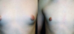 male-breast-bxa2