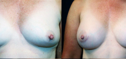 Breast Augmentation