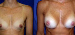 Breast Augmentation