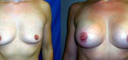 Breast Augmentation