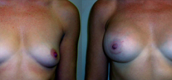 Breast Augmentation