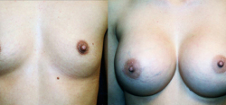 Breast Plastic Surgery Results The Woodlands