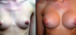 Breast Augmentation