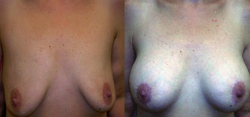 Breast Lift Result The Woodlands