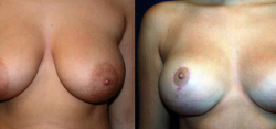 Breast Lift Result The Woodlands