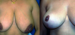 vertical mastopexy without implants