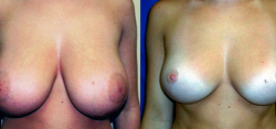 vertical mastopexy without implants