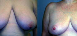 breast-reduction-bxa1
