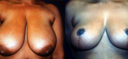 breast-reduction-bxa4