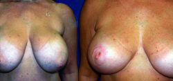 breast-reduction-bxa6