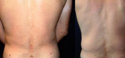 Liposuction Result The Woodlands