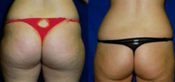 Liposuction Result The Woodlands