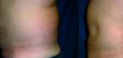 Liposuction Result The Woodlands