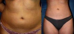 Mommy Makeover Liposuction Results The Woodlands