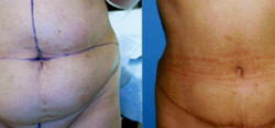 Tummy Tuck Result The Woodlands