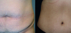 Tummy Tuck Result The Woodlands