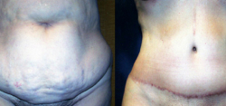 Tummy Tuck Result The Woodlands