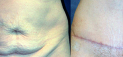 Tummy Tuck Result The Woodlands