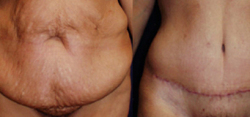 Tummy Tuck Result The Woodlands