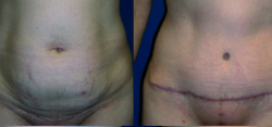 Tummy Tuck Result The Woodlands