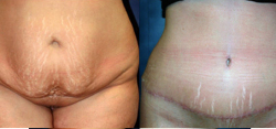 Tummy Tuck Result The Woodlands