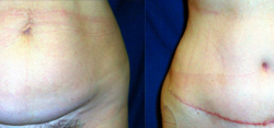 Tummy Tuck Result The Woodlands