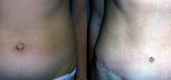 Tummy Tuck Result The Woodlands