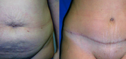 Tummy Tuck Result The Woodlands