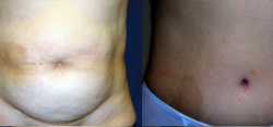 Tummy Tuck Result The Woodlands