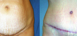 Tummy Tuck Result The Woodlands