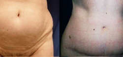 Tummy Tuck Result The Woodlands