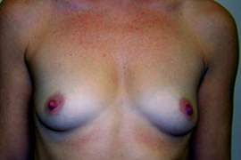 Breast Augmentation Before and After Results