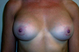 Breast Augmentation Before and After Results