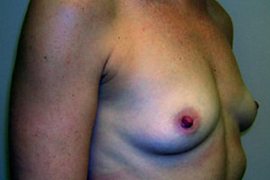 Breast Augmentation Before and After Results