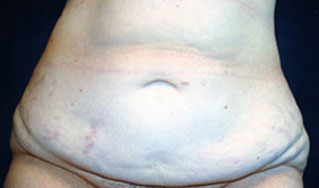 Tummy Tuck Results The Woodlands
