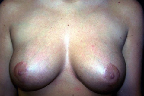 Breast Reduction Results The Woodlands