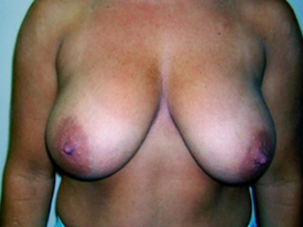 Breast Reduction Results The Woodlands