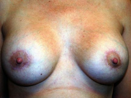 Breast Lift Results The Woodlands