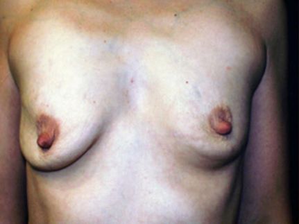 Breast Lift Results The Woodlands